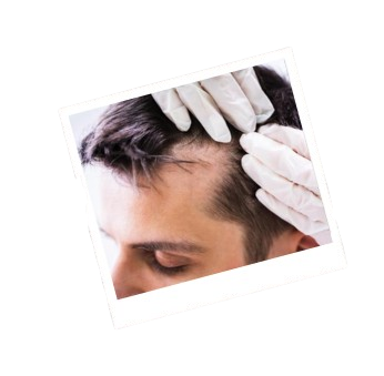 Hair Transplant