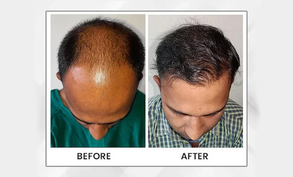 Hair Transplant Results in delhi