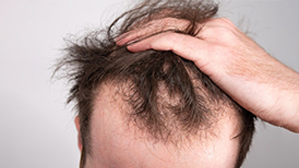 Best Hair Transplant Solutions for Male Pattern Baldness