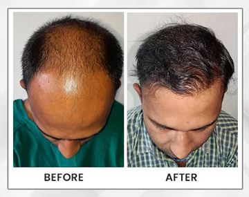 The Ultimate Transformation Exploring the World of Hair Transplant Procedures