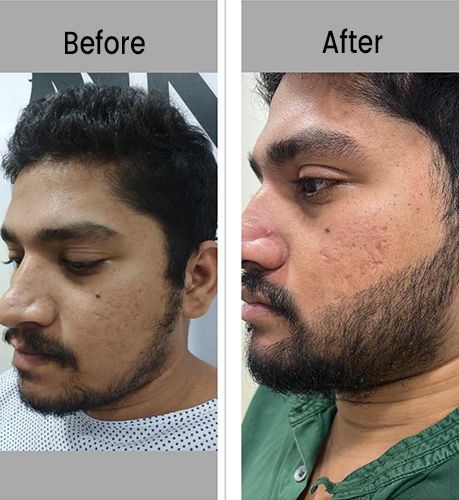 Beard Hair Transplant in Bangalore Rural