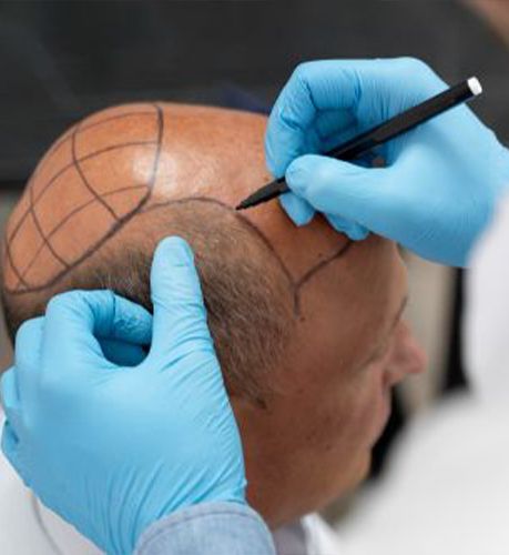 Bio FUE Hair Transplant in Ontario