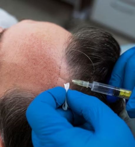 Body Hair Transplant in Belarus