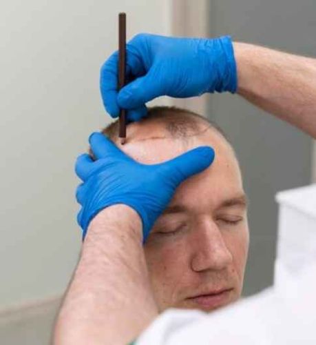 Hair Transplant Cost in Delhi