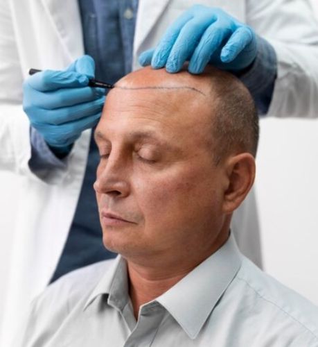 Hair Transplant in Delhi