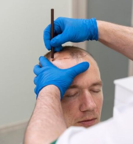 Hairline Reconstruction Treatment in Ontario