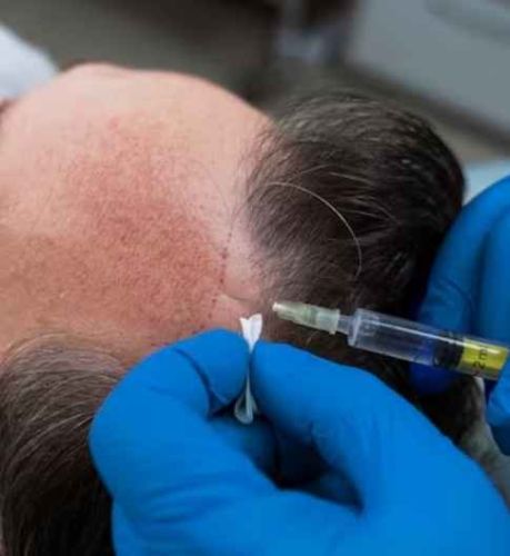 MDFI Hair Transplant in Ontario