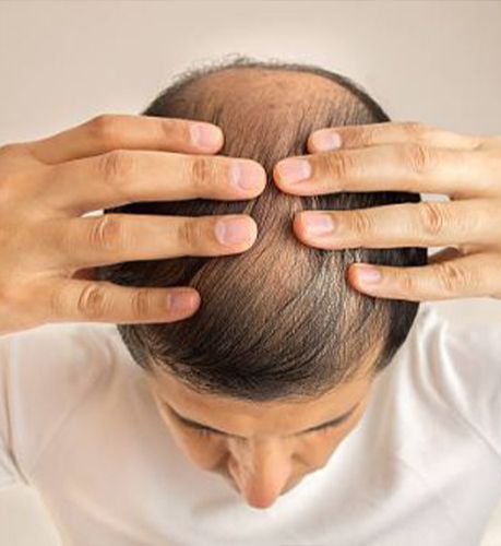 Sapphire FUE Hair Transplant in Belarus