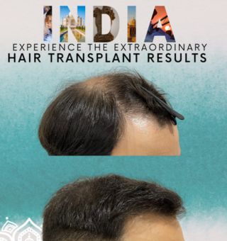 Hair Transplant Clinic in India