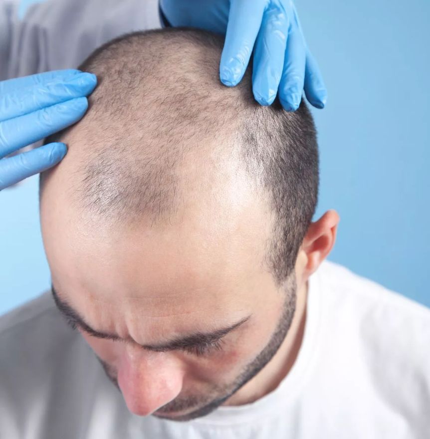 Hair Transplant in India